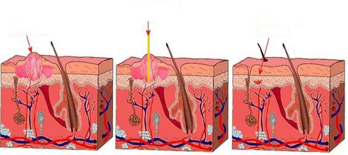 How the laser works on papillomas