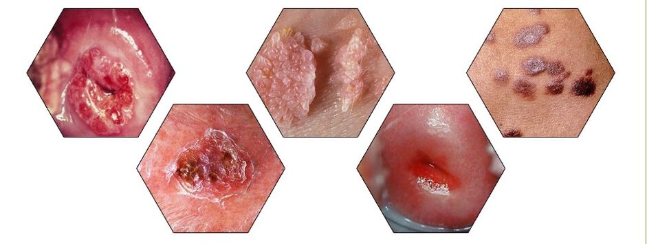types of dangerous papillomas