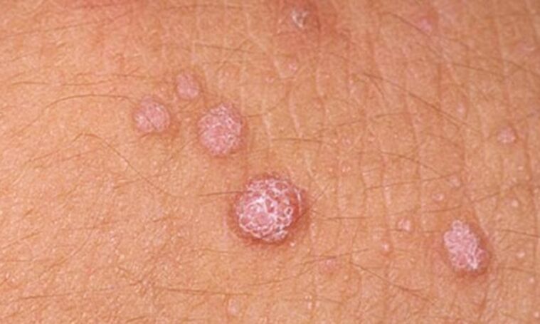 HPV causes the appearance of papillomas on the skin
