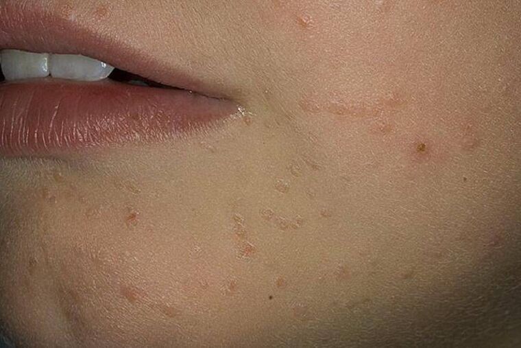 Papillomas on the face