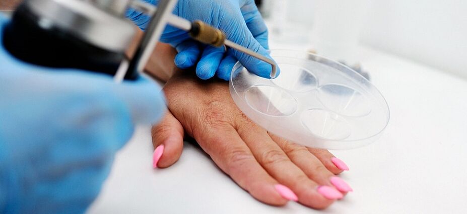 professional wart removal by hand
