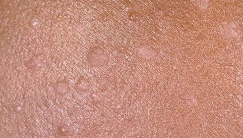 Flat warts on human skin