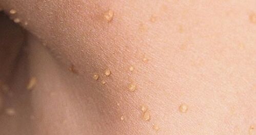 How does the human papillomavirus manifest itself