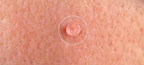 genital warts on the body