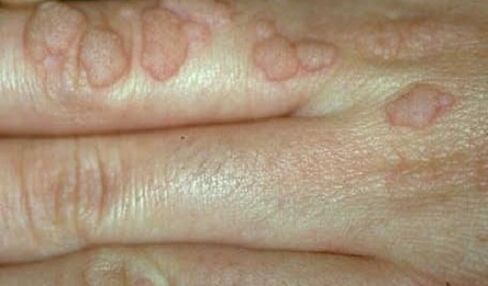 human papillomavirus of the hands