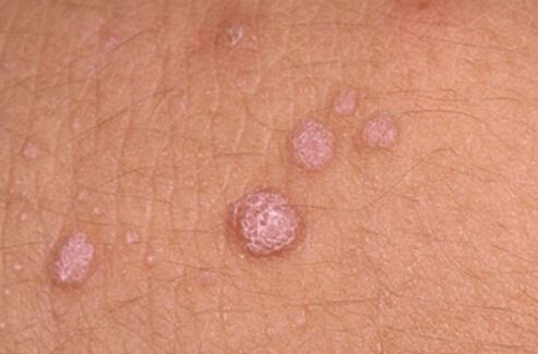 symptoms of human papilloma virus