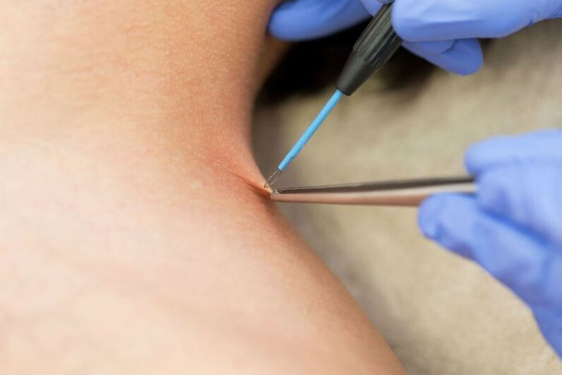 The procedure for removing the papilloma by electrocoagulation