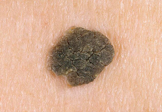 wart on the skin