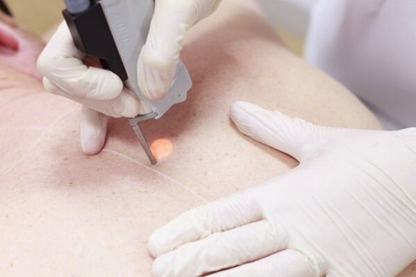 A popular method of removing papillomas with a laser