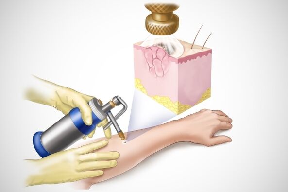 Cryosurgery of papillomas