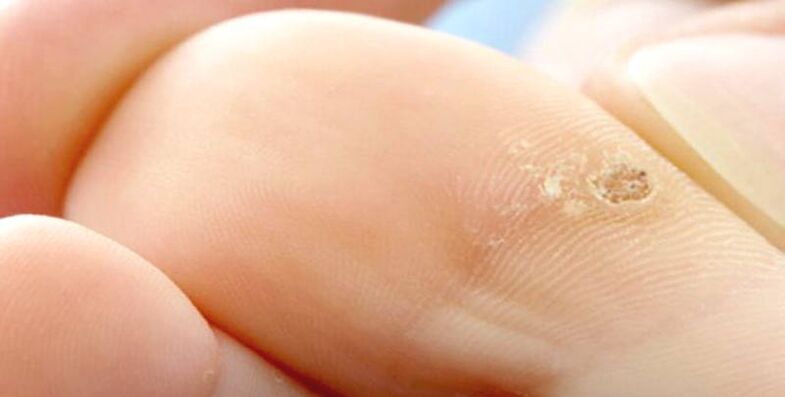 A thorn on the finger