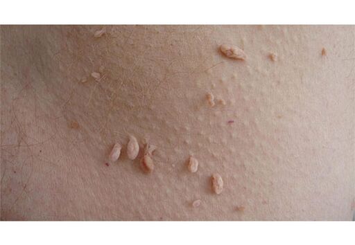 A sign of HPV infection is the appearance of papillomas on the body