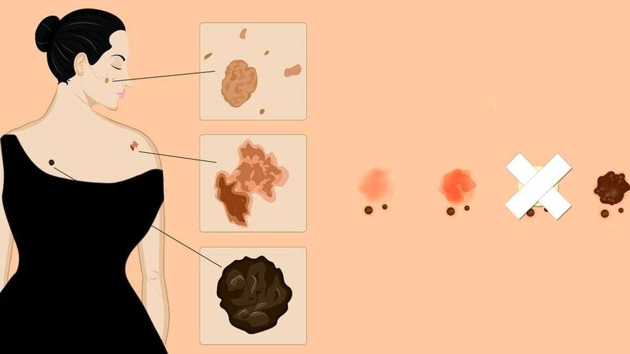 Types of papillomas on human skin