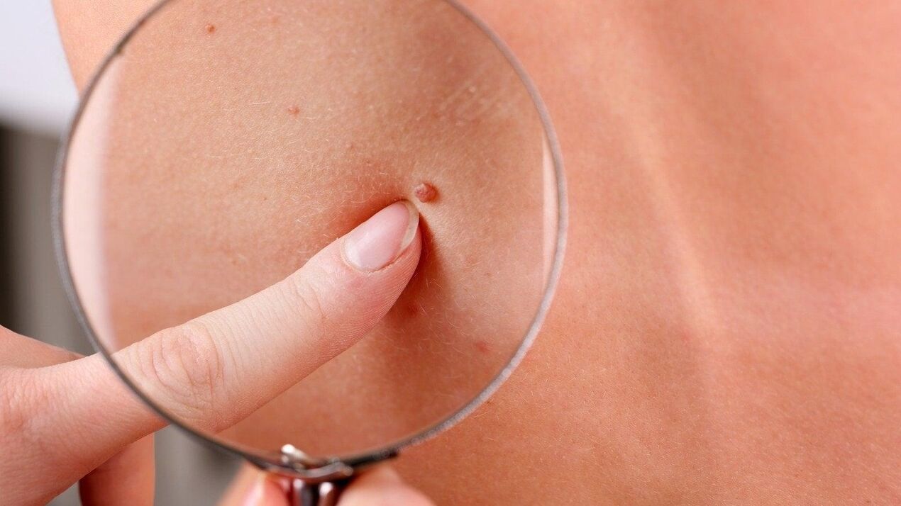 papillomas in the axillary region