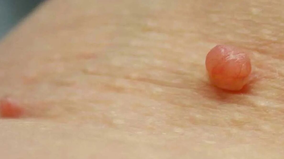 removal of papillomas at home