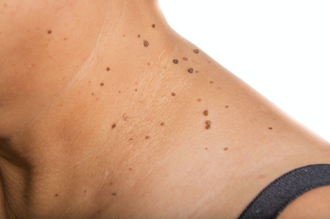 spreading papillomas on the neck
