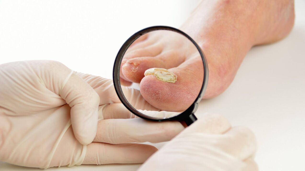 treatment of nail fungus with Keramin cream
