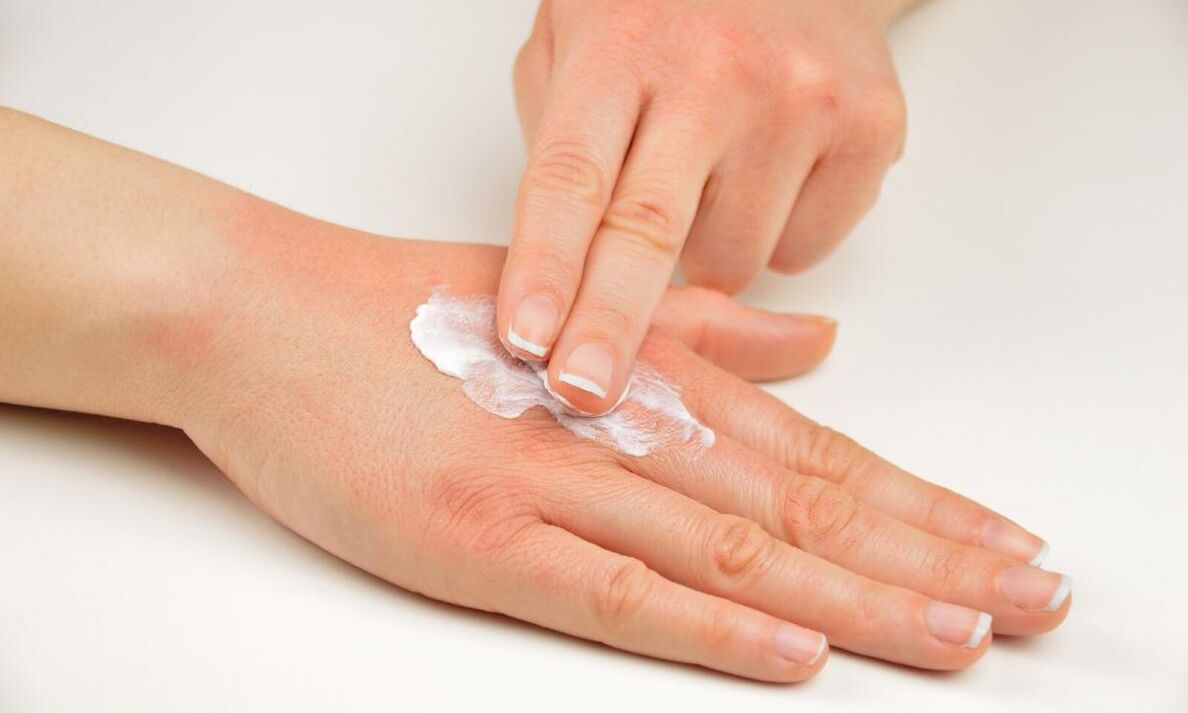 treatment of psoriasis with Keramin cream